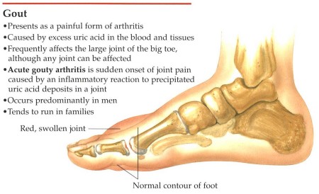 Gout-disease-fact