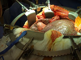 liver-transplant