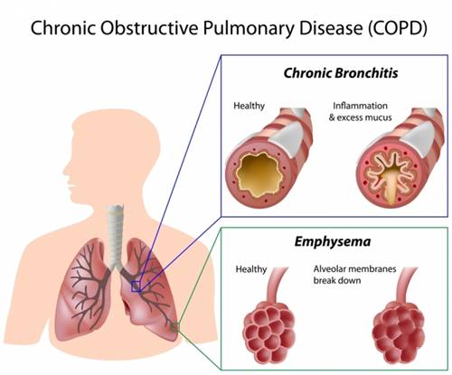 copd_