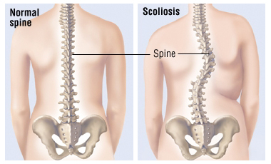 whatis-scoliosis