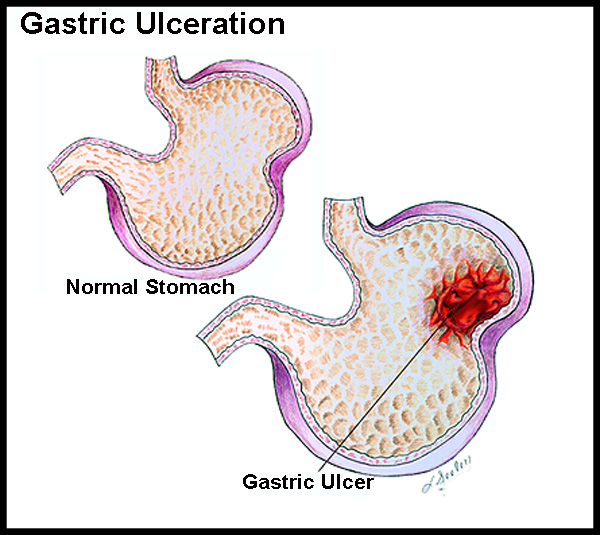 gastric