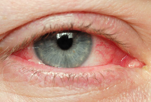 Redness Eye