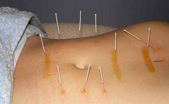 How_acupuncture_works