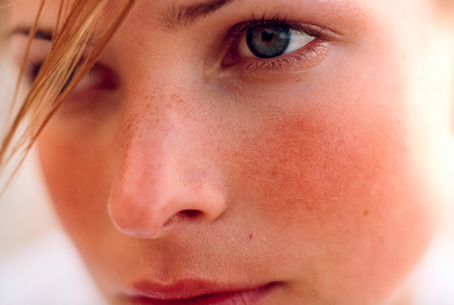 rosacea2