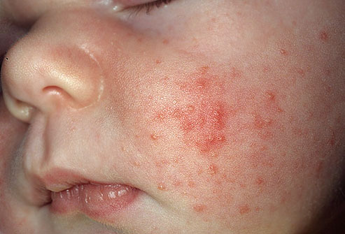 baby-acne