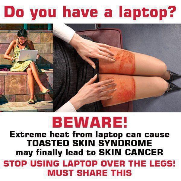 laptop-toasted-skin-syndrome