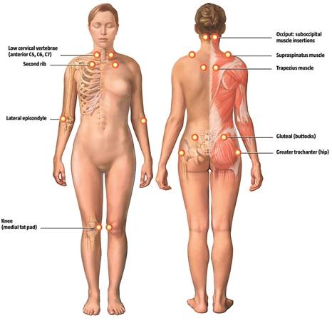 Fibromyalgia-anatomy