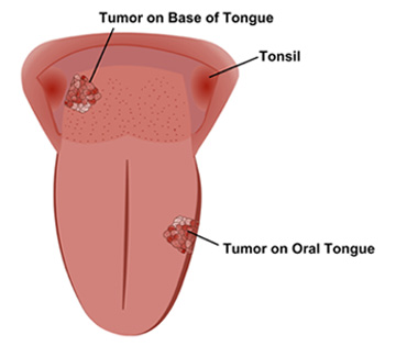 Watch out for tongue cancer - Health Blog Centre Info