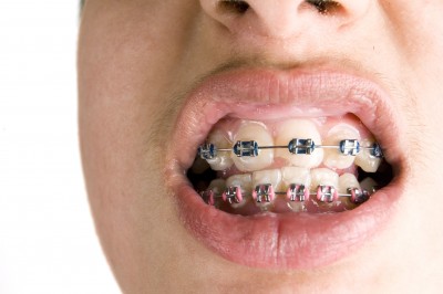 braces wearing know cavities things foods teeth avoid while oral should whilst wanna england preventing guest hygiene dental health yourhealthblog