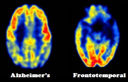 DEMENTIA-alzheimers-ftd-PET-2013