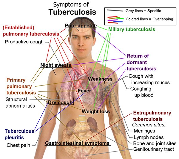 tuberculosis_symptoms