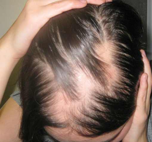 cure-for-hair-loss