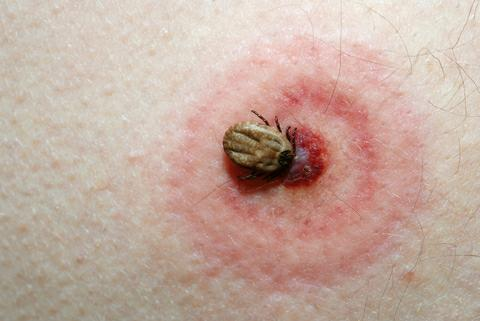 Lyme disease symptom